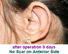 plastic-surgery-prominent-ear 